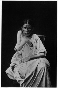 Fénykép egy féloldali epilepsziában szenvedő betegről, a Salpetrière, Bourneville és P. Regnard, Párizs „” fényképes ikonográfiájában alkotó: French Photographer