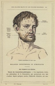 Az akut takony jellegzetes ütései (színes litho) alkotó: French School