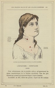 A scrofulosis jellegzetes balesetei a másodlagos időszakban (színes litho) alkotó: French School