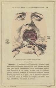 Helyileg alkalmazható készítmény felvitele a mandulára ecsettel (színes litho). alkotó: French School
