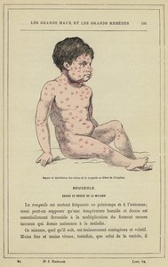 A kanyarófoltok megjelenése és eloszlása ​​a kitörés kezdetén (színes litho) alkotó: French School