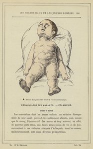 Egy kisgyermek hozzáállása eklampsziás görcsökben (színes litho) alkotó: French School
