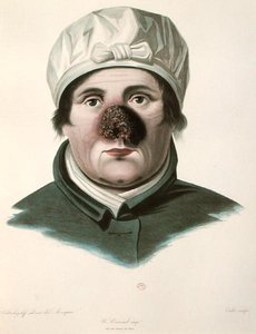 Bőrátültetés előtt, Alexander Auvert „Selecta Praxis Medico-Chirurgica”-tól, Párizs alkotó: French School