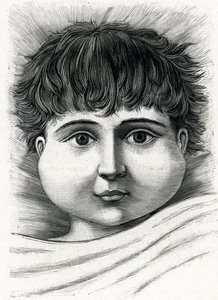 Mumpszos gyermek (metszet) 1888 alkotó: French School