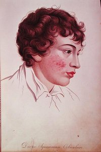 Száraz tapasz, Jean Louis Alibert (1768-1837) báró „Description des Maladies de la Peau” című művéből alkotó: French School