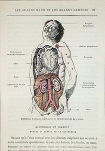 A cukorbetegség hatásai, Dr. J. Rengade „Les Grands Meaux et les Grands Remedes” című művéből, Párizs alkotó: French School
