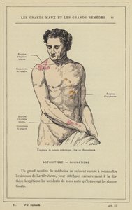 Arthritises jellegű kitörések reumás betegeknél (színes litho) alkotó: French School