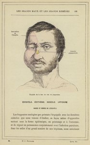 Progresszív erysipela arcra (színes litho) alkotó: French School