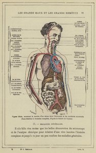 Ideális ábra, amely a vírus fejlődését a gazdaságban és a diatézis egymást követő baleseteit mutatja be teljes evolúcióval a szerző elmélete szerint (színes litho) alkotó: French School