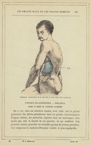 A lép jellegzetes duzzanata maláriás láz során (színes litho) alkotó: French School