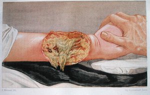 Kórházi gangréna, Edmund Delorme (1847-1929) "Traite de Chirurgie de Guerre" című művéből, metszette F. Meheux. alkotó: French School