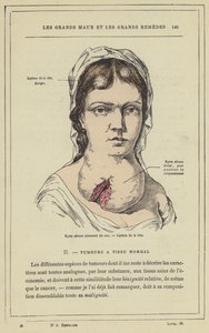 Cloisonne savós ciszta a nyakon, lipoma a fejen (színes litho) alkotó: French School