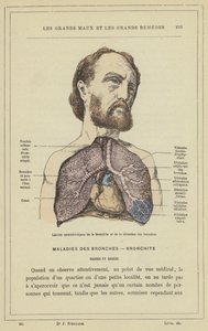 Hörghurutra és hörgőtágulatra jellemző elváltozások (színes litho) alkotó: French School