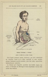 A tífusz jellegzetes elváltozásai (színes litho) alkotó: French School