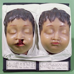 Modell, amely egy gyermek arcát mutatja az Antoine Dubois (1756-1837) által 1799-ben végzett nyúl ajak korrekciójára irányuló műtét előtt és után (viasz) alkotó: French School