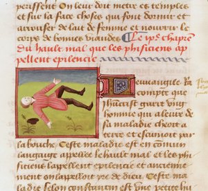 Ms 22532 Epilepsziás rohamban szenvedő beteg, Barthelemy langlais A dolgok tulajdonságainak könyve c. 1410-15 alkotó: French School