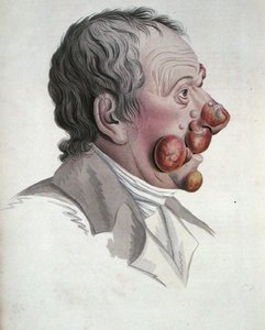 Mycosis Fongoide, Jean Louis Alibert báró (1768-1837) könyvéből 1838 (színes metszet) alkotó: French School
