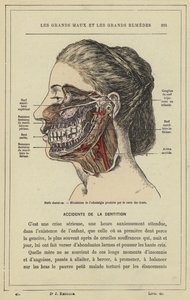 Fogidegek, A fogszuvasodás által okozott odontalgia mechanizmusa (színes litho) alkotó: French School