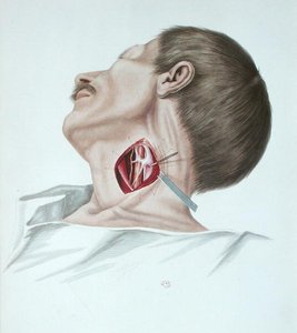 Műtét egy aneurizmán, Alexander Auvert "Selecta Praxis Medico-Chirurgica" című művéből, Párizs, Párizs. alkotó: French School