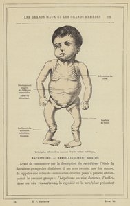 Fő csontdeformációk angolkóros gyermeknél (színes litho) alkotó: French School