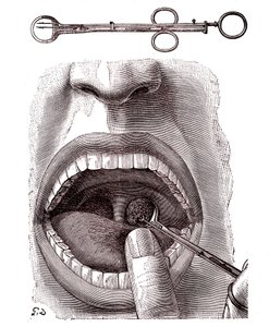 Tonsillectomy. 1887 (engraving) alkotó: French School