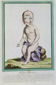 Gyermek deformált fejjel, a Les Ecarts de la Nature-ből, Párizs, 1775