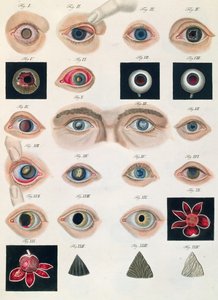A veleszületett szem anomáliák leírása az emberi szem betegségeinek és látáshibáinak klinikai bemutatásából, Friedrich August von Ammon (1799-1861) 1838 alkotó: German School