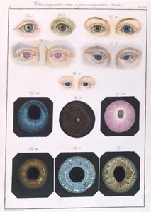 A veleszületett szem anomáliák leírása az emberi szem betegségeinek és látáshibáinak klinikai bemutatásából, Friedrich August von Ammon (1799-1861) 1838 alkotó: German School