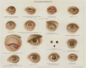 Szembetegségek (színes litho) alkotó: German School