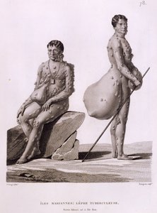 Északi-Mariana-szigetek: Két tuberkulózisban szenvedő férfi, Bourgeois által metszett „Voyage Autour du Monde sur les Corvettes de L