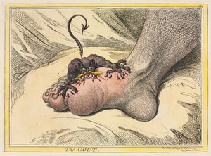 A köszvény, 1799. alkotó: James Gillray