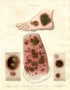 Kóros bőrbetegségek - Pityria;Impetigo és szifilisz