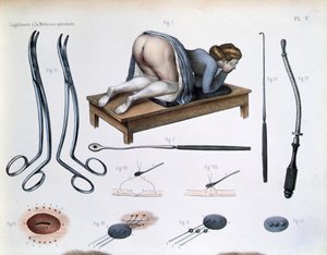 Hólyagos-vaginális sipoly műtétje, Jean-Baptiste Marc Bourgery (1797-1849) „Traite Complet de l