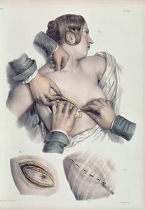 Rákos daganat műtétje, Jean-Baptiste Marc Bourgery (1797-1849) „Traite Complet de l