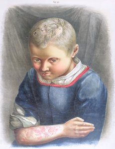 Favus, Daniel Cornelius Danielssen (1815-94) könyvéből, 1892 alkotó: Norwegian School