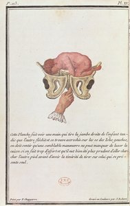 Az anyaméhből a karjánál fogva kihúzott baba keresztmetszeti diagramja Madame Angelique Le Boursier du Coudray (1714-94) J. Robert által metszett könyvéből, 1783 alkotó: P. Chapparre