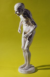 Parkinson-kóros nő alakja (gipsz) alkotó: Paul Marie Louis Pierre Richer