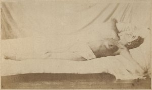 Hisztérikus epilepszia, roham, keresztre feszítés, VI. tábla az „Iconographie Photographique de La Salpetriere”-ből, Bourneville et P. Regnard, Párizs, 1876 (albumnyomat)