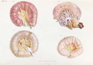 A kolerával fertőzött belek külső felülete az Anatomie Pathologique du Cholera Morbus-tól, Nyikolaj Ivanovics Pirogov (1810-81) Szentpéterváron, 1849 alkotó: Russian School