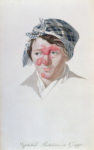 Szifiliás pustulák, báró Jean Louis Alibert (1768-1837) könyvéből, 1838