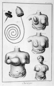 Mellsebészet, 1751-1777 alkotó: Unbekannt