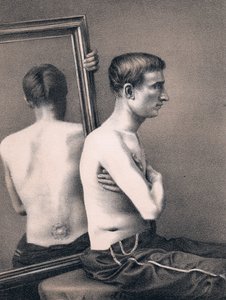 Egy hasi golyós seb felépülése, amerikai polgárháború, 1865 alkotó: Unbekannt
