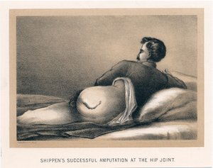 Shippens sikeres csípőízületi amputációja, amerikai polgárháború, 1865 alkotó: Unbekannt
