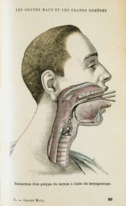 Laringoszkóp használata a polip eltávolításának elősegítésére a torokból, c1890 alkotó: Unbekannt