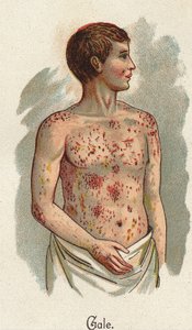 Gyermekbetegségek: A rüh. F.E. Bilz „Az új természetes gyógyszer” című könyvében. alkotó: Unknown artist