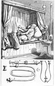 Clystère (beöntésekhez), Johannes Sculptetus „” Armamentarium Surgical””. Velence 1665 alkotó: Unknown artist