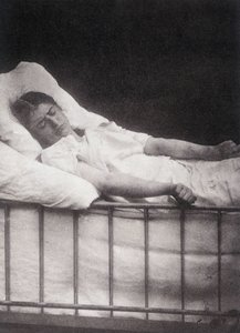 Hystero Epilepsia – Tetanizmus támadás a „Salpétrière fényképes ikonográfiájában: Mr. Charcot szolgálata” Paul Regnard és Bourneville alkotó: Unknown artist