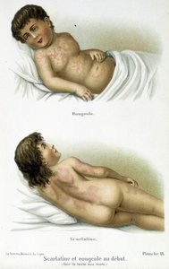 Skarlát és kanyaró – 19. század alkotó: Unknown artist