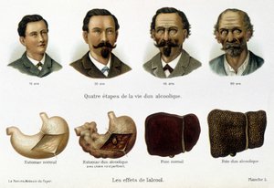 Az alkohol hatásai: az alkoholista életének négy szakasza, amelyet az arca és a máj képvisel. - a „nő, házi orvos”-ban alkotó: Unknown artist