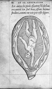 A magzat helyzete a méhben a terhesség alatt. Ambroise Pare francia orvos és sebész (1509-1590) „De la Generation des enfants” című metszete XVI. alkotó: Unknown artist